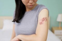 Shingles cases dropping among people who got chickenpox vaccine, data shows