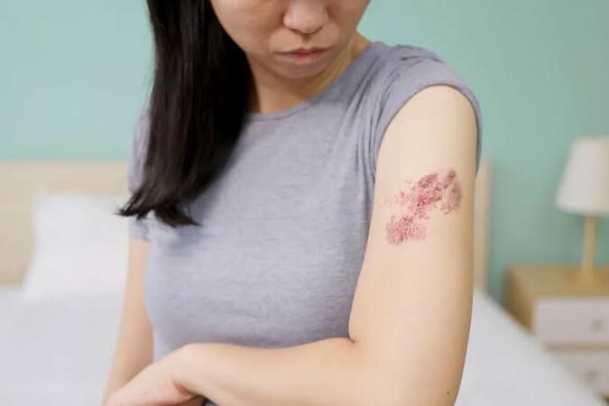 Shingles cases dropping among people who got chickenpox vaccine, data shows