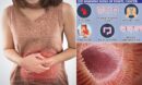 ?Scientists reveal the exact diet to follow to stave off bowel cancer-will you make the swap