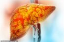 Scientists discover key cause of deadly liver disease – new treatment on the horizon